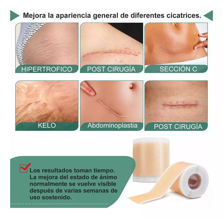 Rollo Cinta Elimina Cicatrices Queloides Silicona 4cmx1.5mts